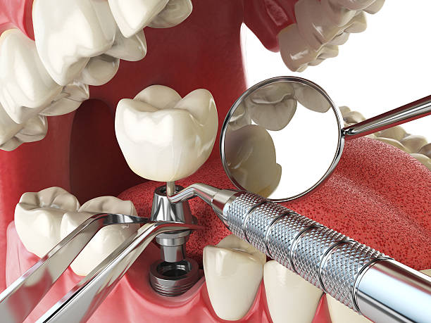 Best Emergency Tooth Extraction in Los Osos, CA